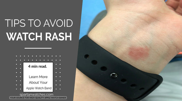 How To Avoid Apple Watch Rash